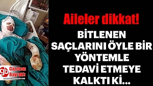 Lise Öğrencisi Bitlenen Saçlarını Benzinle Yıkamak İsterken Kendini Yaktı