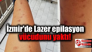 İzmir'de Lazer epilasyon vücudunu yaktı