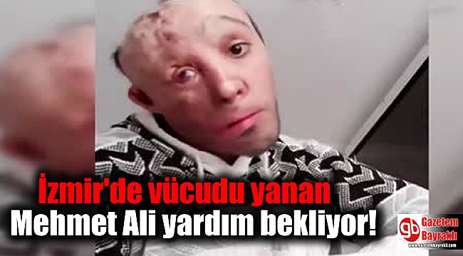 İzmir'de vücudu yanan Mehmet Ali yardım bekliyor