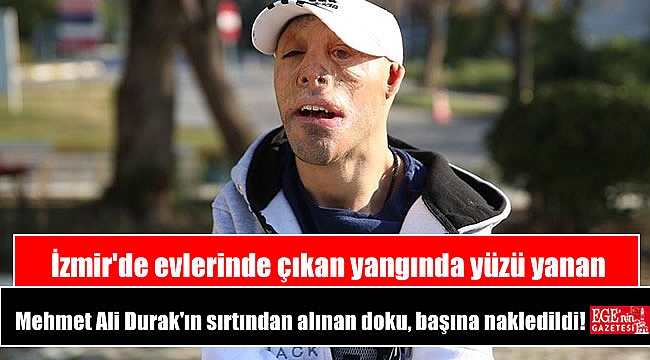 İzmir'de evlerinde çıkan yangın sonucu vücudunun büyük bir kısmı ile yüzü yanan Mehmet Ali Durak'ın sırtından alınan doku, başına nakledildi